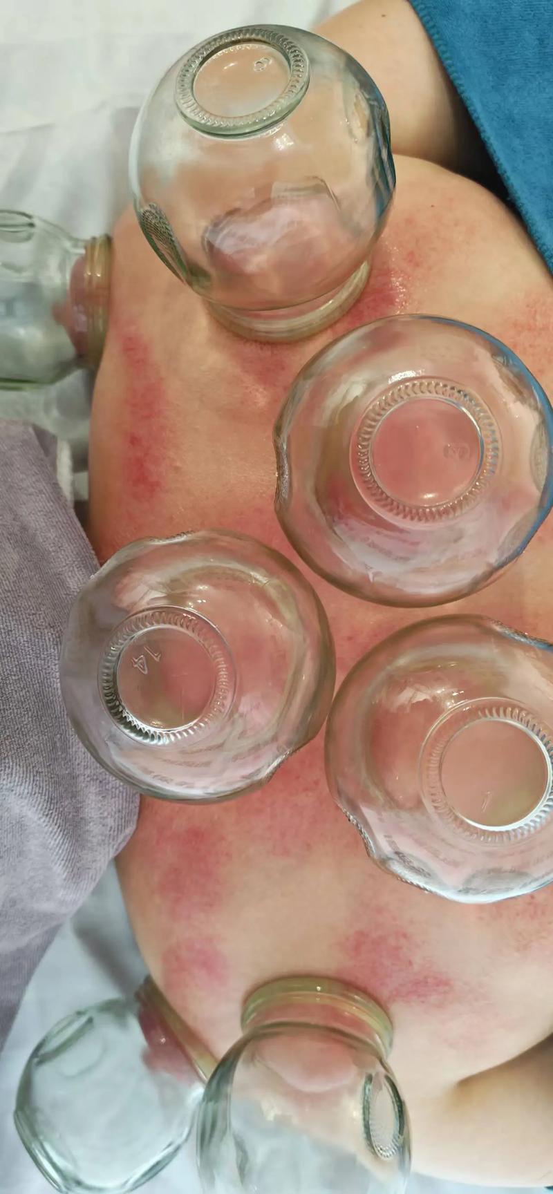 艾灸棒：健康养生的便捷选择